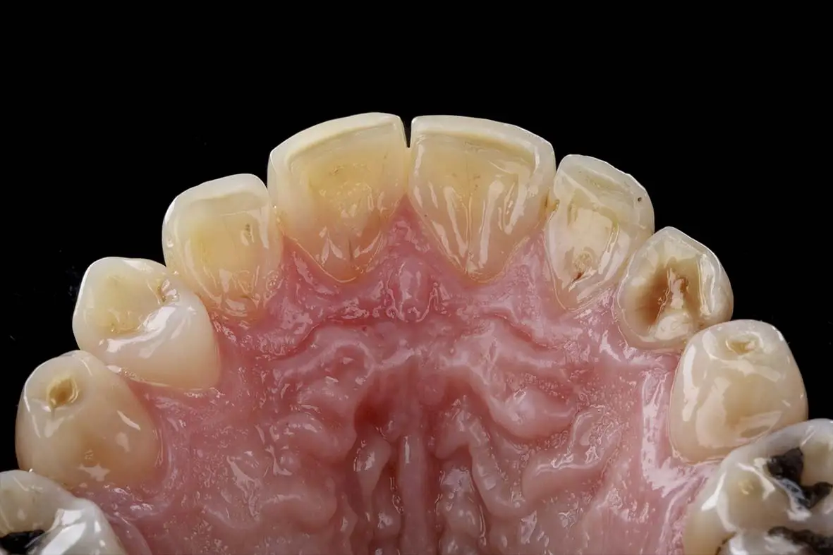 transposição dentária